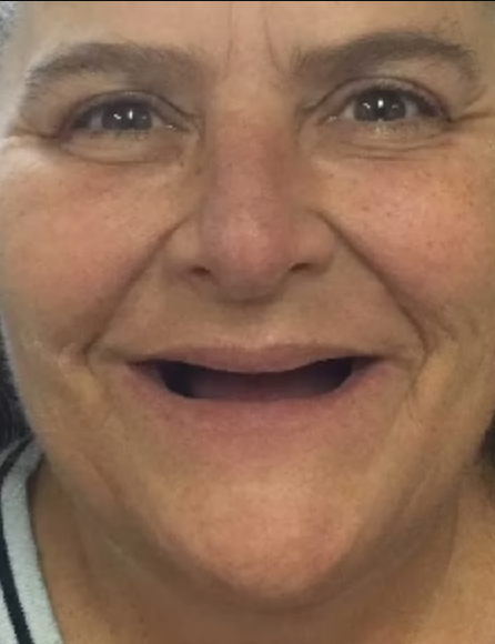 Before image for Melissa Turner