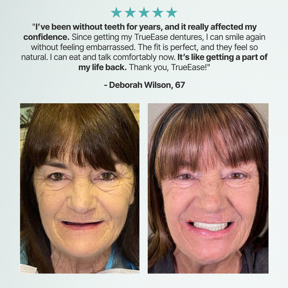 SmileFit™ Custom-Fit Full Functional Dentures